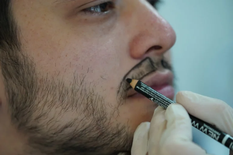 Mustache Transplant