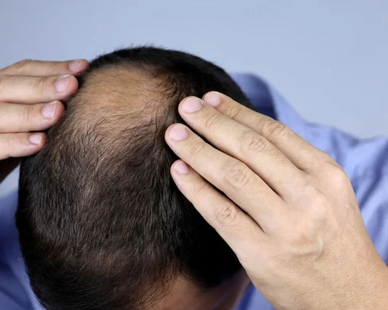Advanced Hair Fall & Hair Growth Treatment in Pune