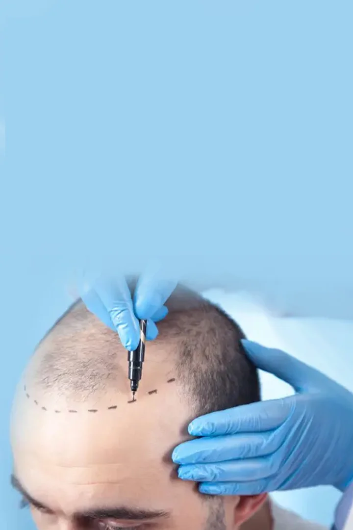 Transform Your Hair, Life - With India's best hair treatment Experts