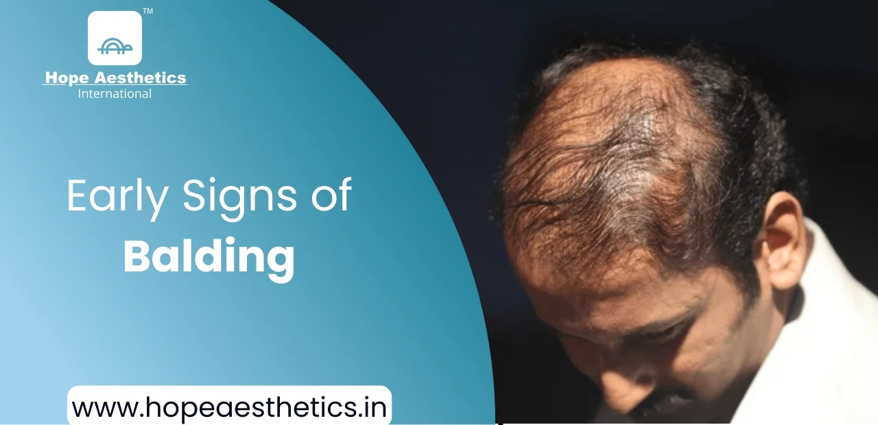 What Are The Early Signs of Balding?