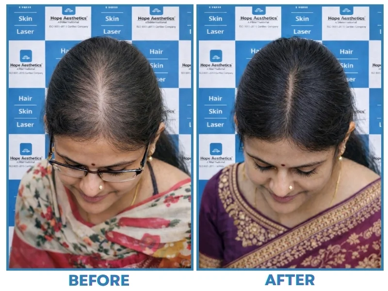 Advanced Hair Restoration Treatments in Pune Hope Aesthetics Clinic
