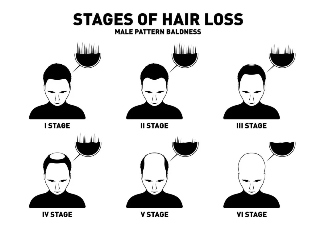 Hair Loss (Permanent Thinning) - Stages of Hair Loss