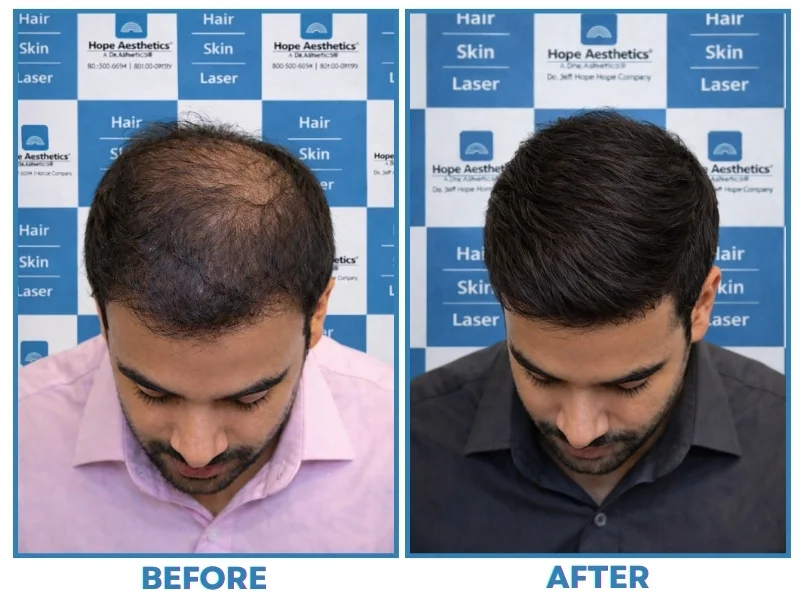 Hair transplant in Pune result – before and after crown hair restoration at Hope Aesthetics Clinic.