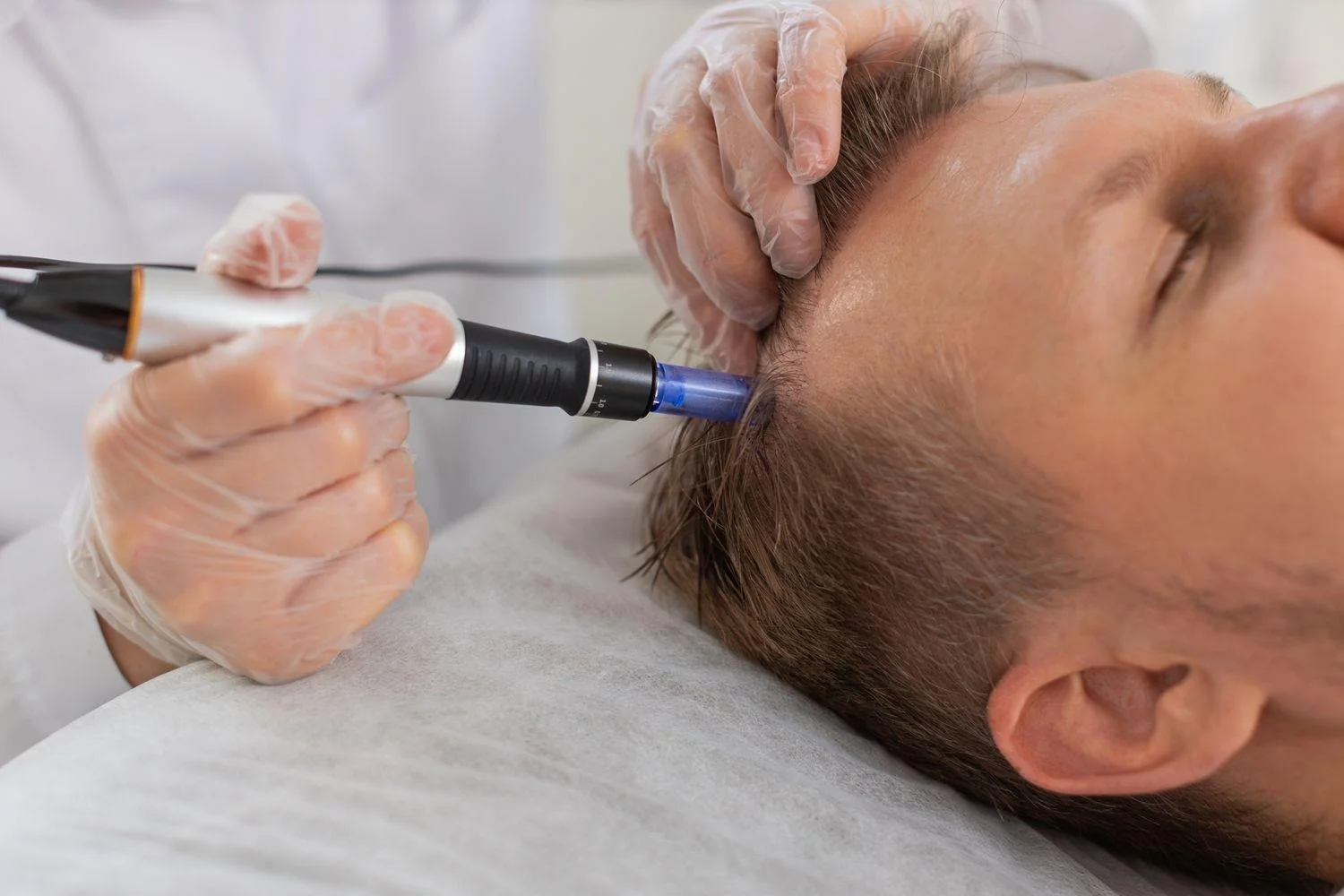 Micro-Needling Treatment for Hair Loss